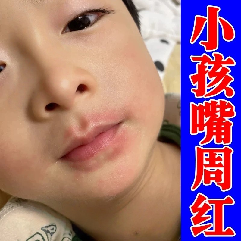治羊胡子疮膏药儿童唇炎小孩舔嘴唇上火嘴巴起泡干裂脱皮红肿疼痛