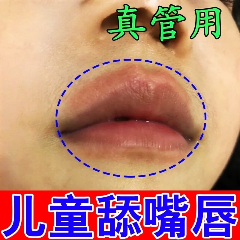 小孩嘴周红儿童羊胡子疮舔嘴唇红肿瘙痒唇炎上火疹疱干裂专用唇膏