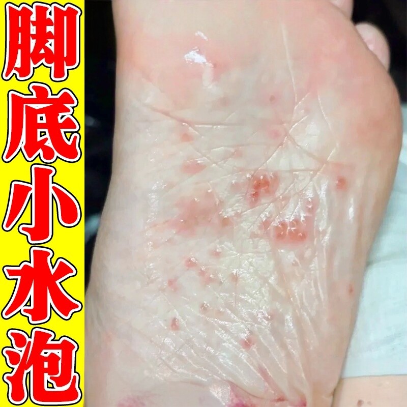 脚底上起小水泡脚痒掉皮烂脚丫治脚掌水疱型脚足底气止痒杀菌膏药