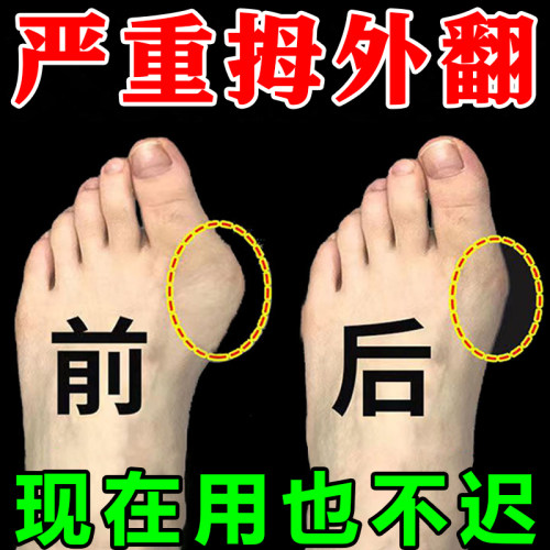 极速【快速消】拇外翻神器矫正大脚骨H疼痛突出脚趾重叠成人专用