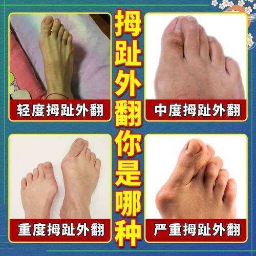 极速【早用早直】拇o指外翻贴大脚骨突出疼痛神器矫正脚趾重叠变