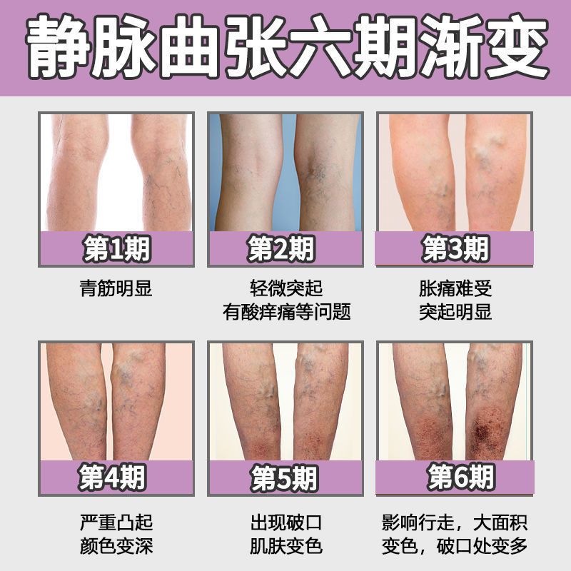 极速【一瓶够用】静脉曲张膏蚯蚓A腿红血丝青筋凸起浮肿麻木痒下