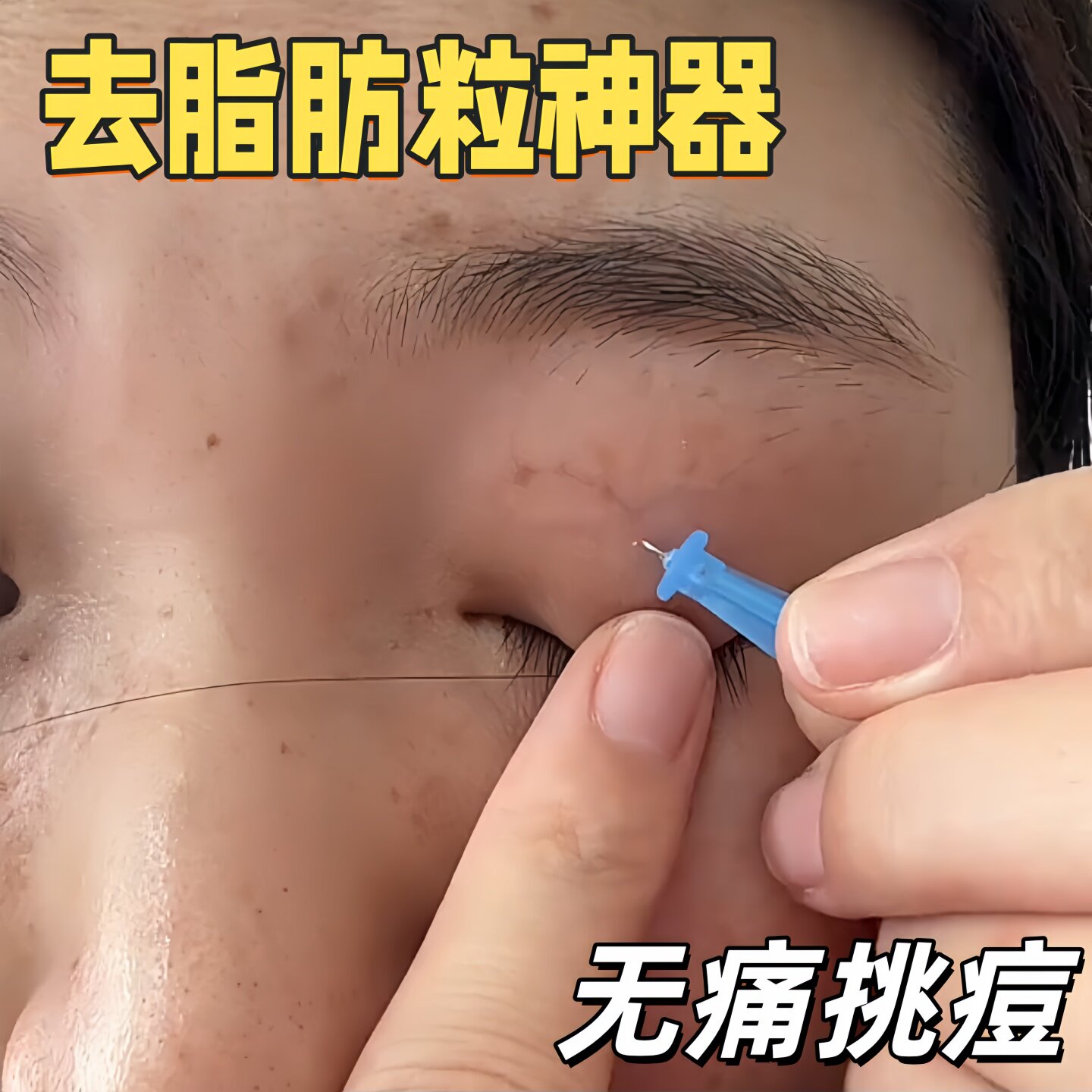 一次性粉刺针脂肪粒去除神器
