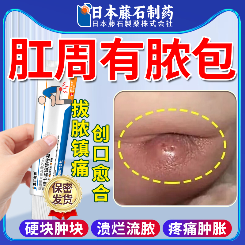 肛周脓肿专用肛瘘封口肛门硬块非坐浴包可搭肛裂愈合膏药房同售AZ