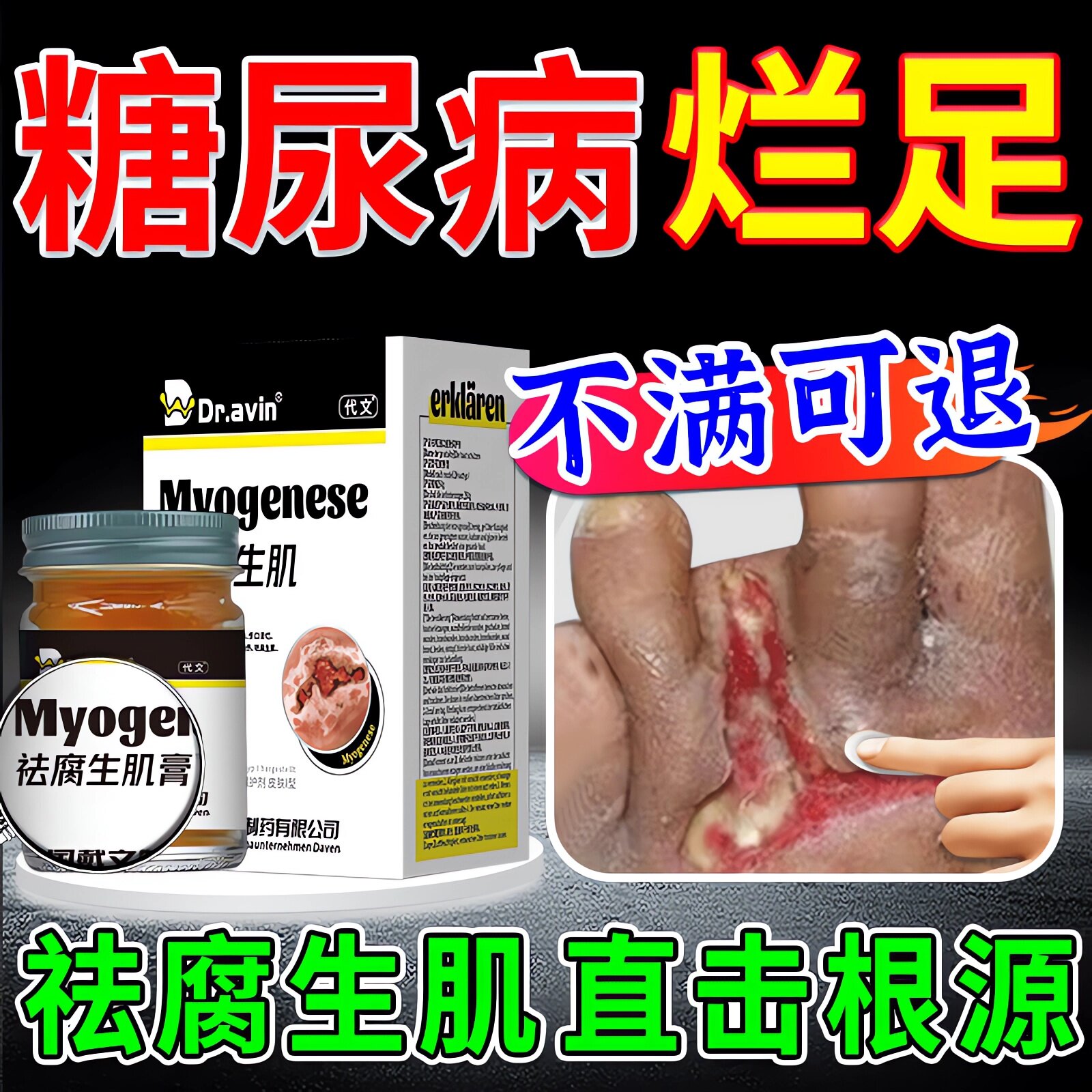 糖尿病烂足专用膏快速祛腐生肌药伤口愈合促进长肉结痂烂脚流脓zr