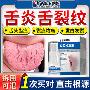 舌炎舌头中间有裂纹齿痕舌康灵喷雾调理地图舌舌苔白厚溃疡灼痛ZR
