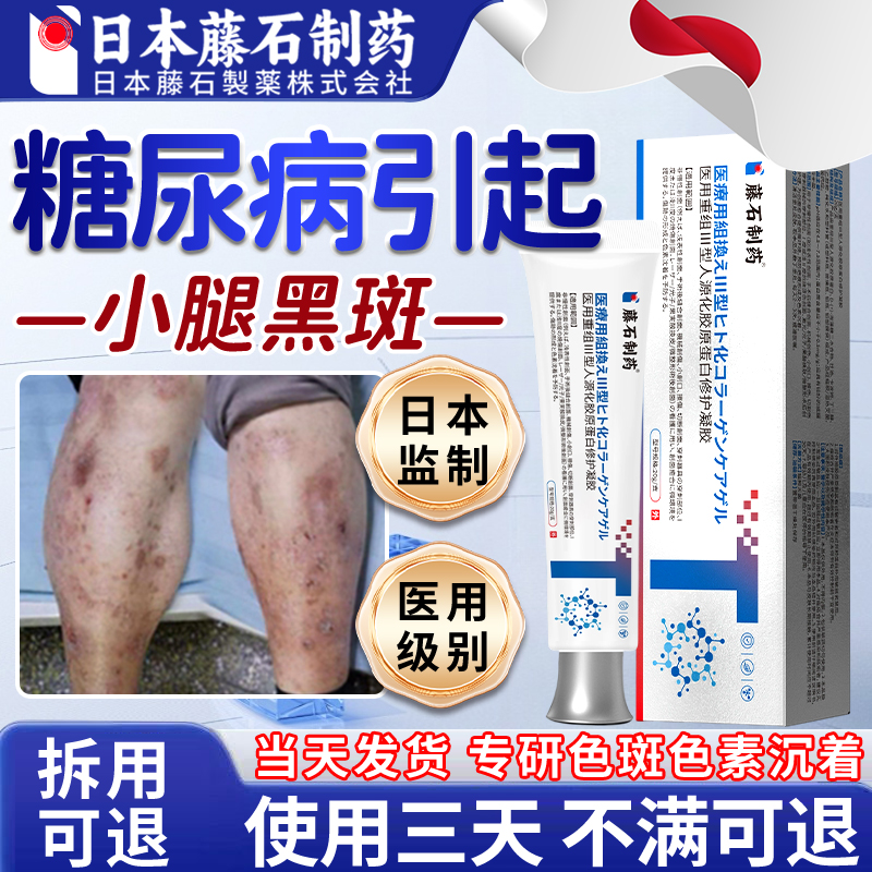 【拆用可退】糖尿病引起小腿黑斑