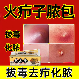 火疖子拔毒膏屁股硬块脓包红疙瘩坐板疮红肿皮肤瘙痒疖子拔脓药膏