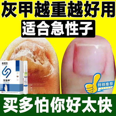 康速达灰指甲医用冷敷凝胶旗舰店正品官方灰指甲手脚甲沟炎抑菌液