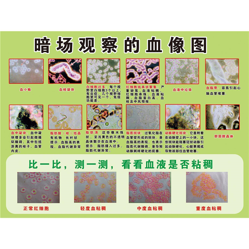人体暗场观察的血像图 红细胞对比图 血管内斑块示意图海报画墙贴