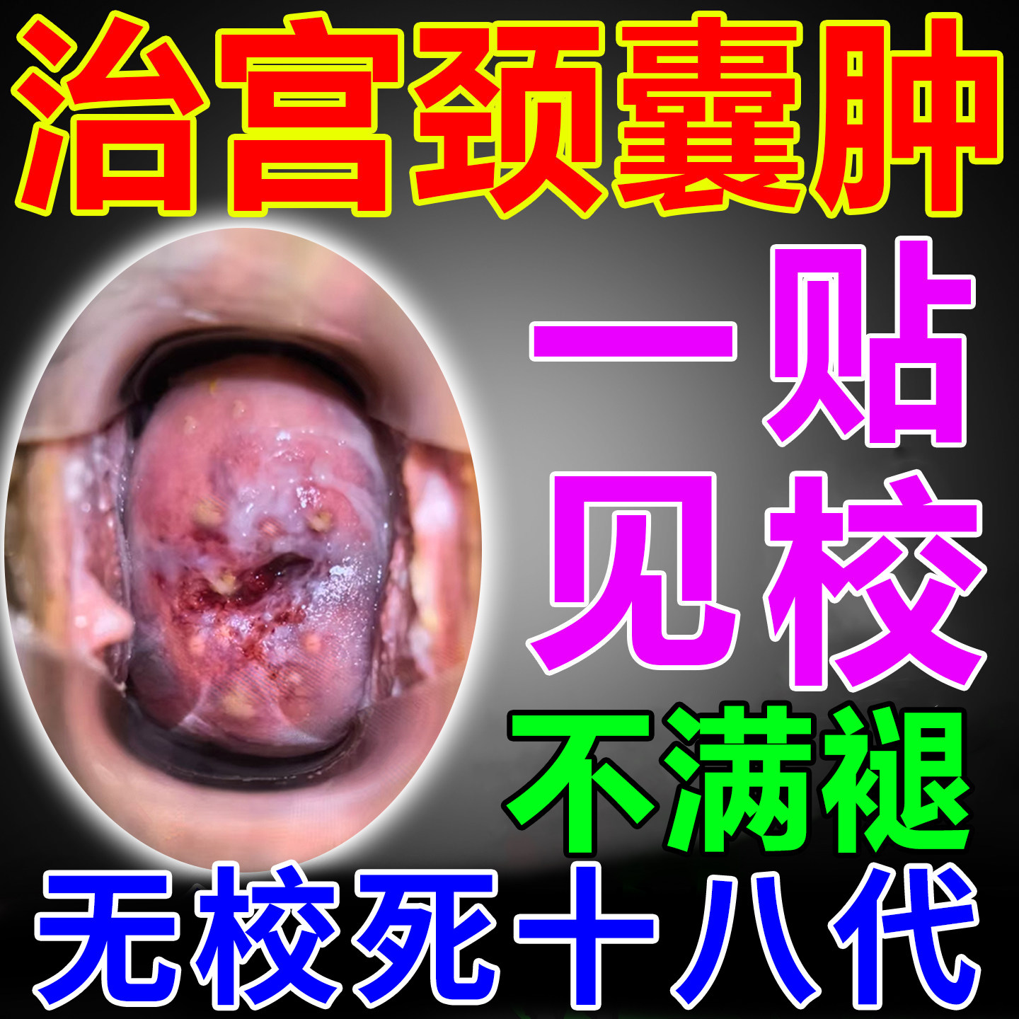 200%消除】宫颈囊肿子宫息肉