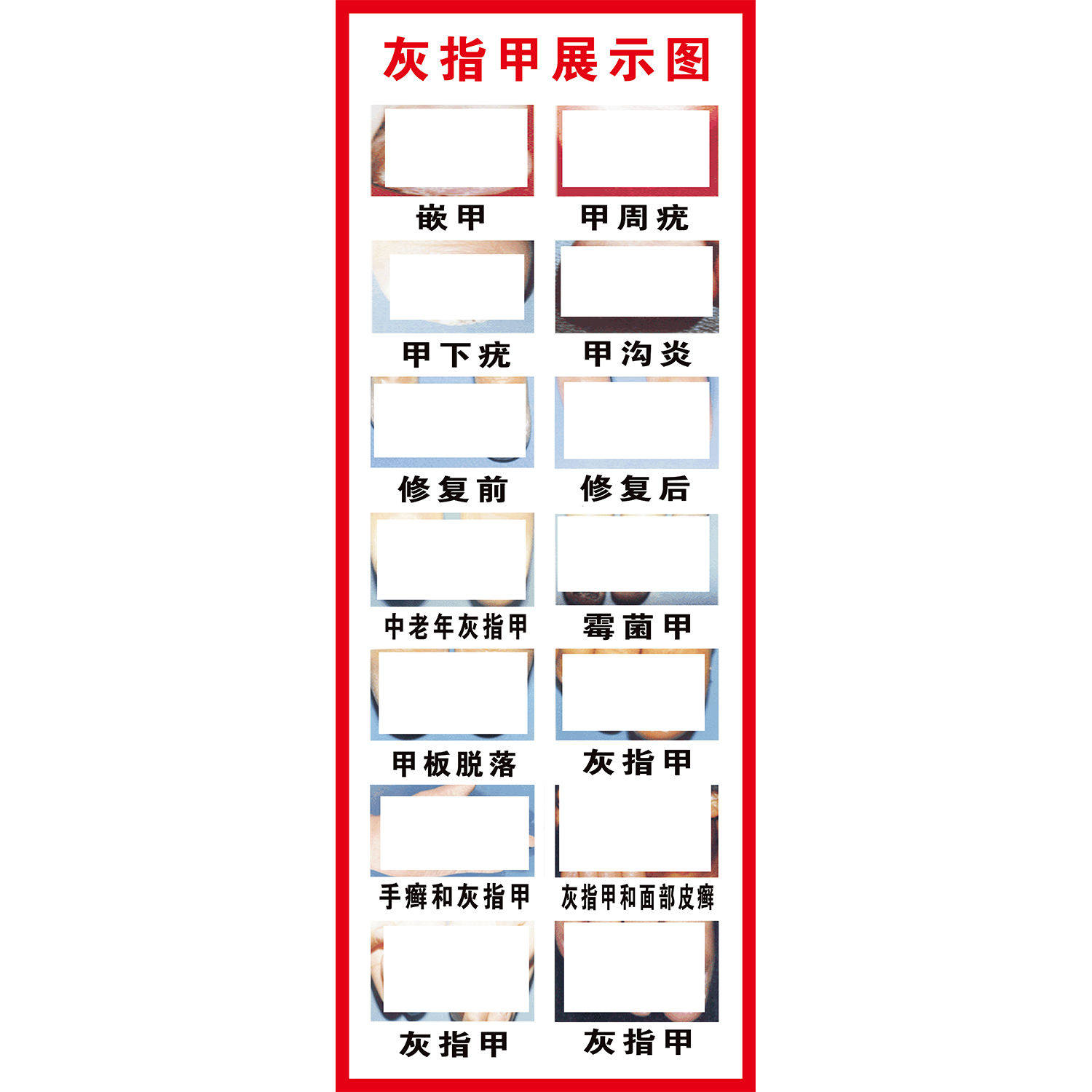 甲沟炎海报甲沟炎危害修脚养生广告宣传画足疗馆墙贴装饰海报图