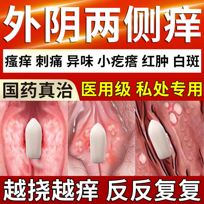 妇科外阴瘙痒专用止痒阴道炎抑菌消炎霉菌性真菌感染硝酸咪康唑栓