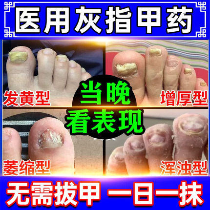 环吡酮胺乳膏灰指甲专用药治甲癣指甲真菌感染抗真菌脱甲坏甲药膏