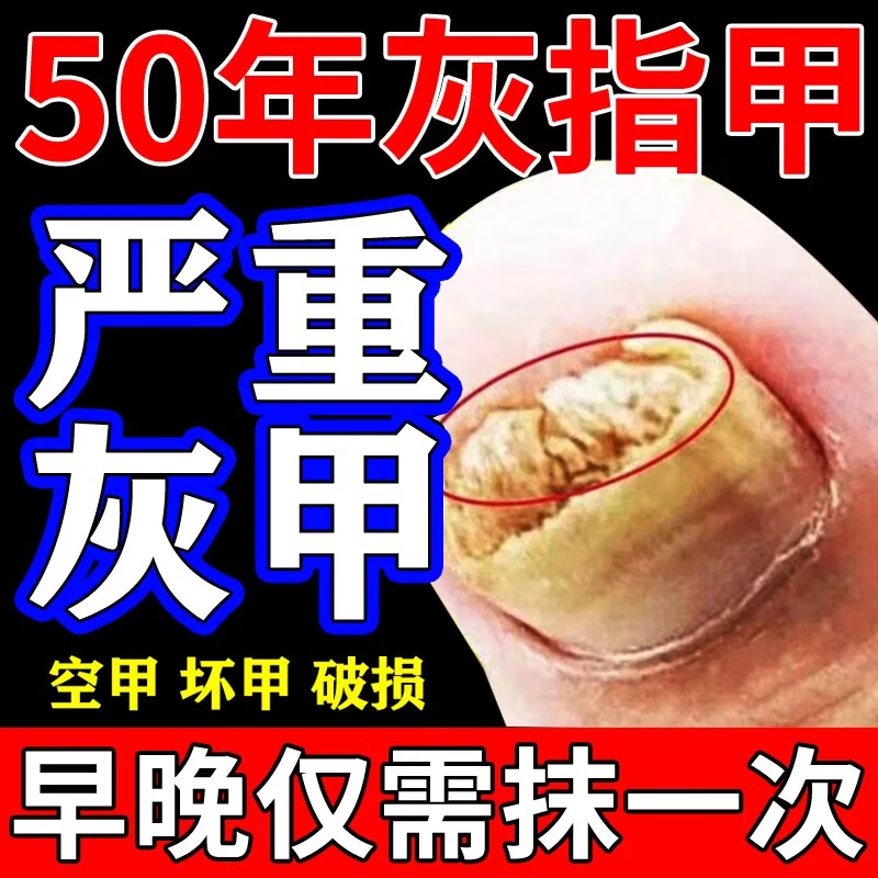 灰指甲治疗专用药正品甲发黄变黑黄真菌感染环吡酮胺乳膏灰指甲