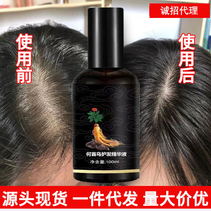防脱育发液增发密发防脱发坚韧发根长发际线头皮护理固发养发液