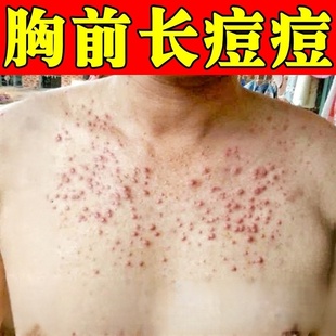 前胸后背长痘痘毛囊膏药胸前痘痘胸口发红发痒长小红点疙瘩专用