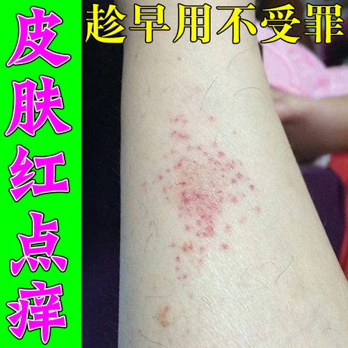 腿上干痒小腿皮肤痒起红疙瘩小红点老年人皮肤干燥粗糙起皮掉屑痒