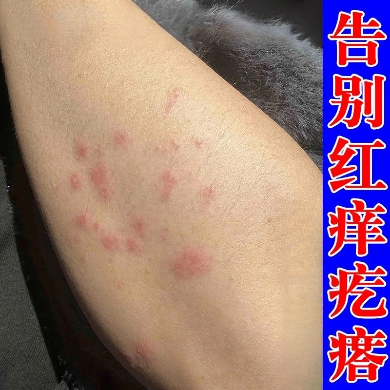 治皮肤痒身上起红疙瘩手臂过敏有红点痒外用喷剂