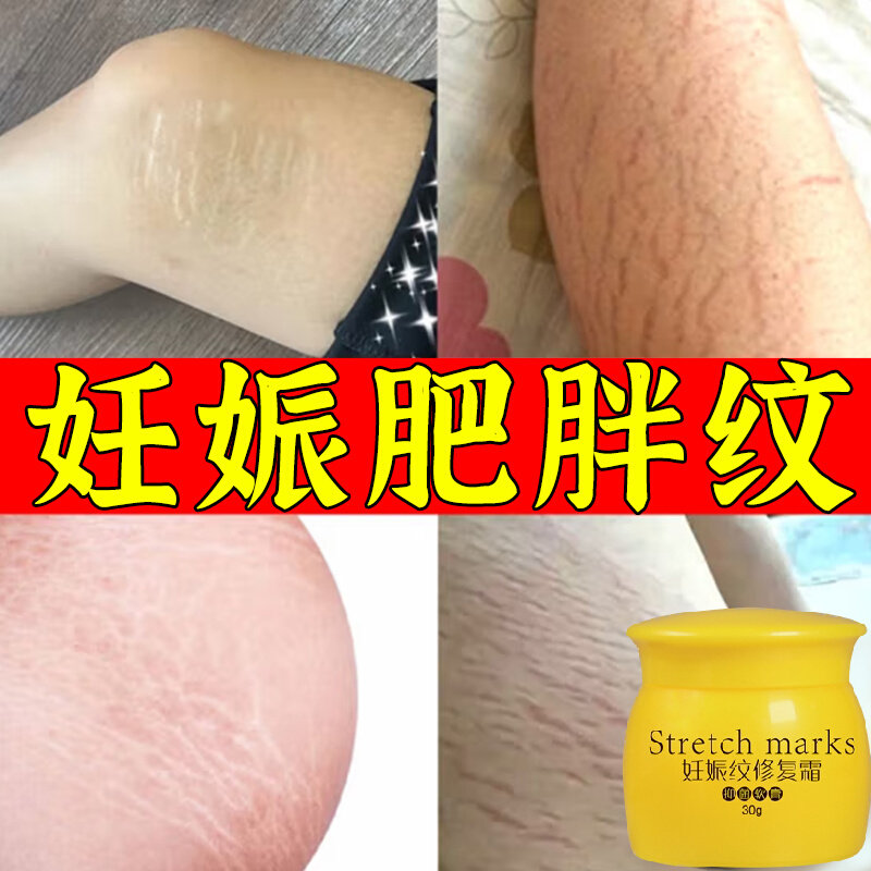 去生长纹肥胖纹修复霜淡化妊娠纹大腿学生身上肥胖纹去除男女通用