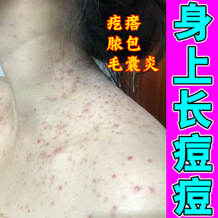 去后背痘痘身上毛囊除螨红肿痒前胸长小疙瘩发红发痒专用修复药