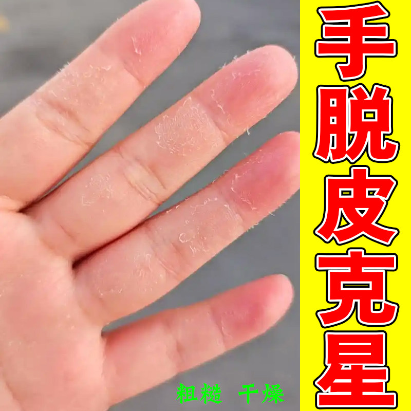 冶疗手脱皮的药膏手指上起皮干燥脚粗糙掉皮足底真菌感染皮肤裂开