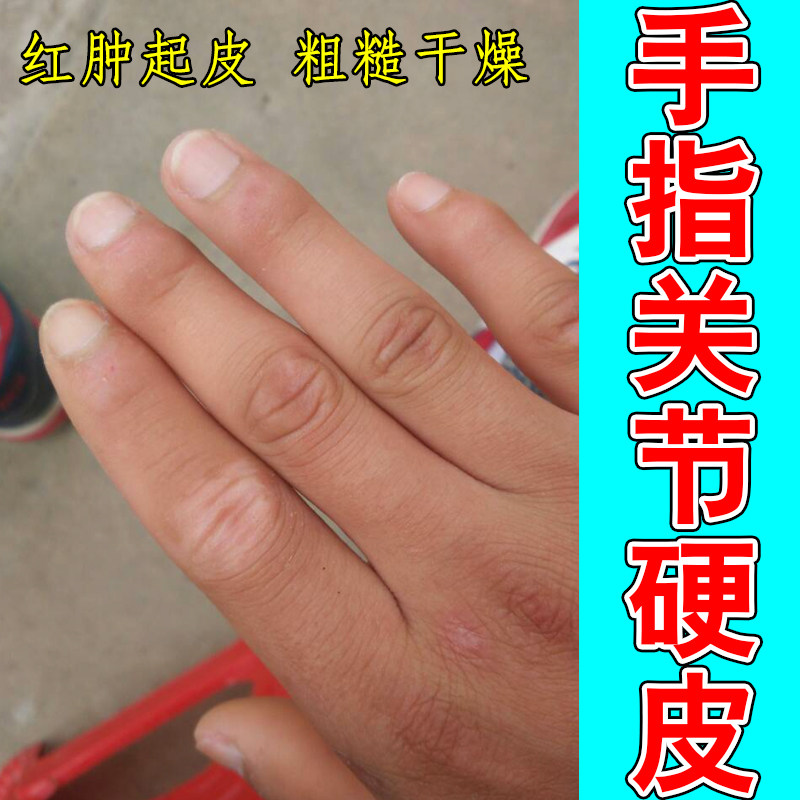 手指关节硬皮粗糙干燥掉屑手部硬肉角质指关节角质凸起老茧草本膏