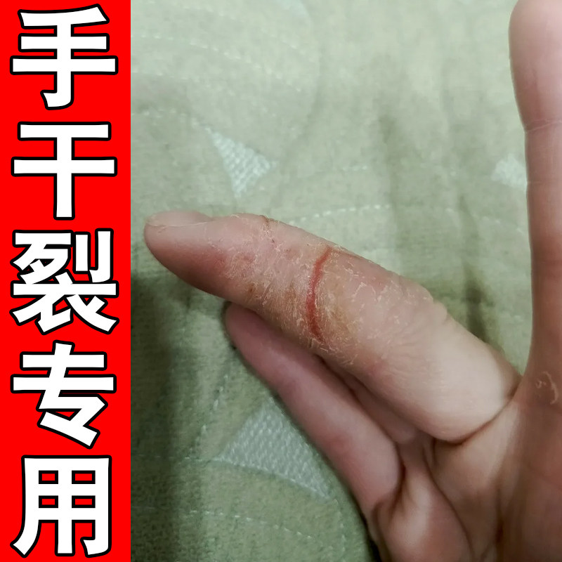 手干裂专用角化型经常洗手皮肤粗糙掉屑起皮裂口子破皮蜕皮草本药