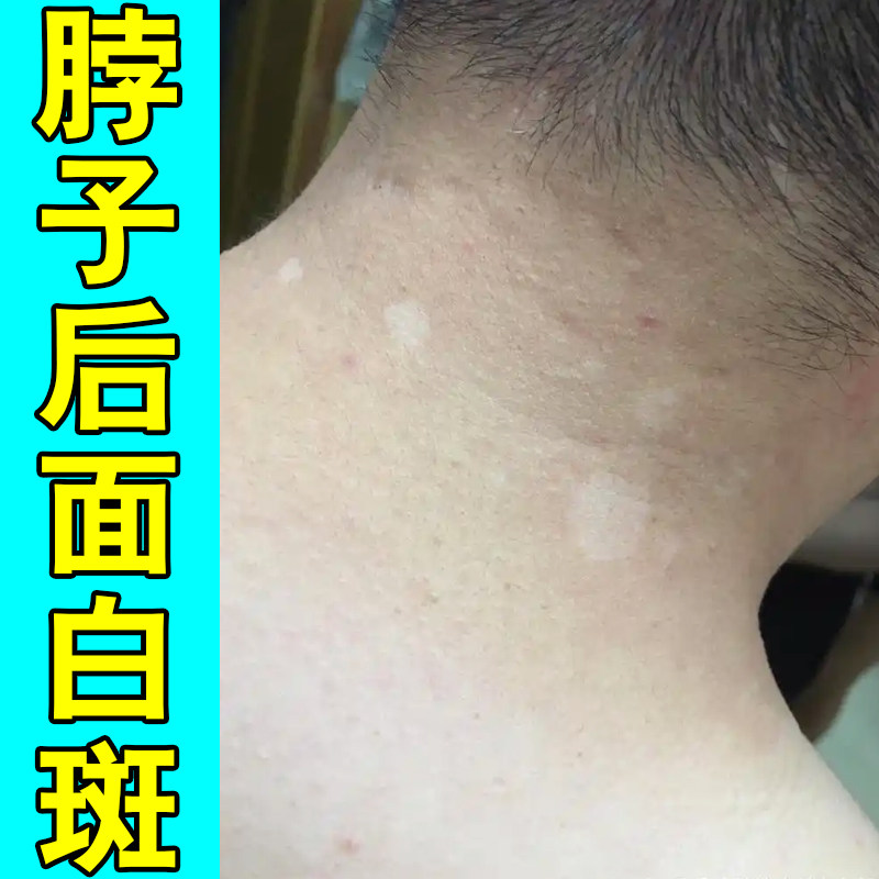 四肢面部浅白斑护理软膏躯干零散白点花斑肌肤肤色不均匀日常外用