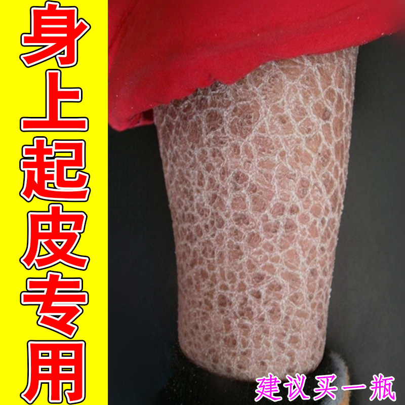 身上起皮专用掉屑粗糙干燥痒换季过敏腿上脱皮蛇皮鱼鳞皮专用保湿