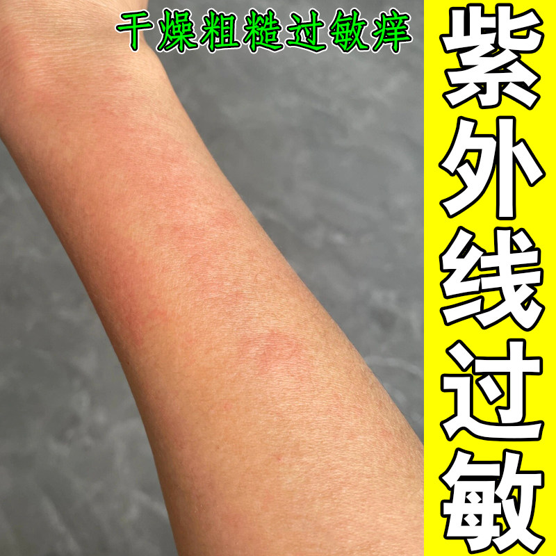 紫外线过敏红肿起红疙瘩长痘痘粗糙掉屑日光性过敏修护保湿药乳膏