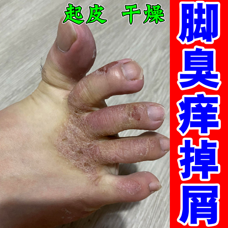 水疱型脚底长水泡皮肤干燥蜕皮痒角质增厚专用修复药乳
