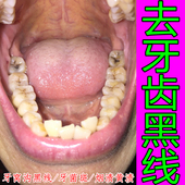 牙齿黑线神器溶解牙石清理工具黄牙黑烟渍牙垢牙菌斑洗牙神器