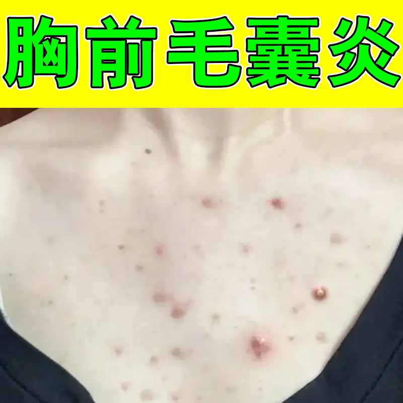 胸前毛囊炎毛孔堵塞马拉色菌感染后背长疙瘩红肿粗糙除螨虫保湿药