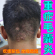 重症毛囊头上长痘痘疙瘩脓包前胸后背马拉色菌毛囊修复药