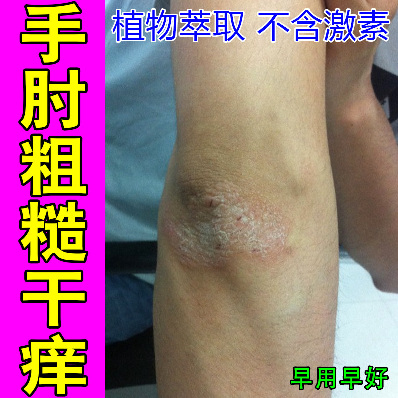 手肘粗糙干痒神经性皮肤红肿过敏痒起皮掉屑角质层增厚顽固剧烈痒