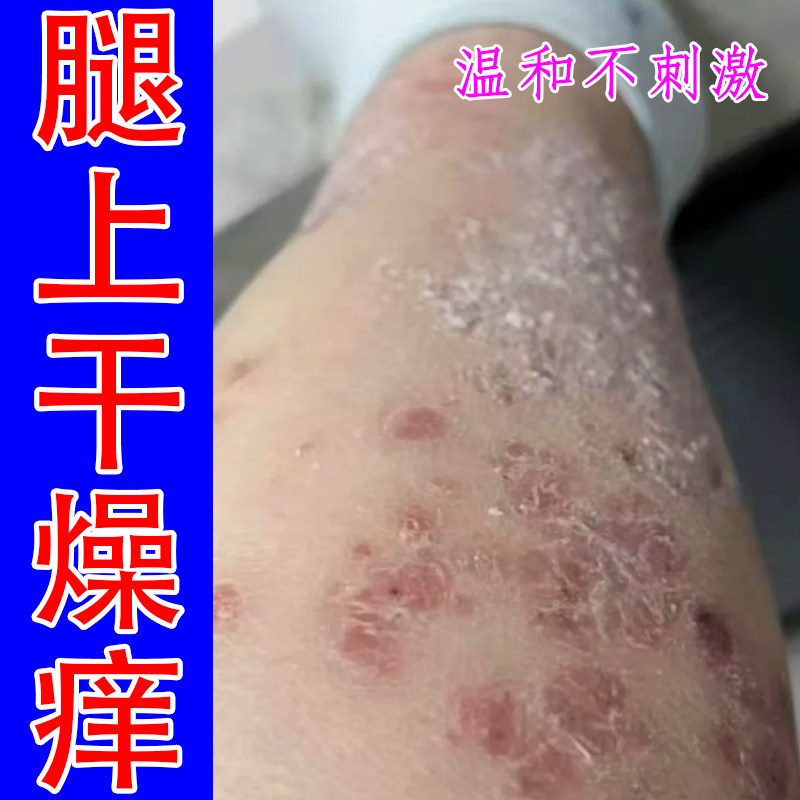 腿上干燥痒起皮过敏痒紫外线神经性老年人皮肤粗糙干专用修护药乳