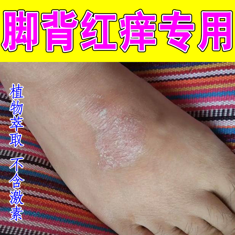 脚背红痒专用起皮增厚掉屑疙瘩刺挠长小红点脚面长痘鳞屑起疹子痒