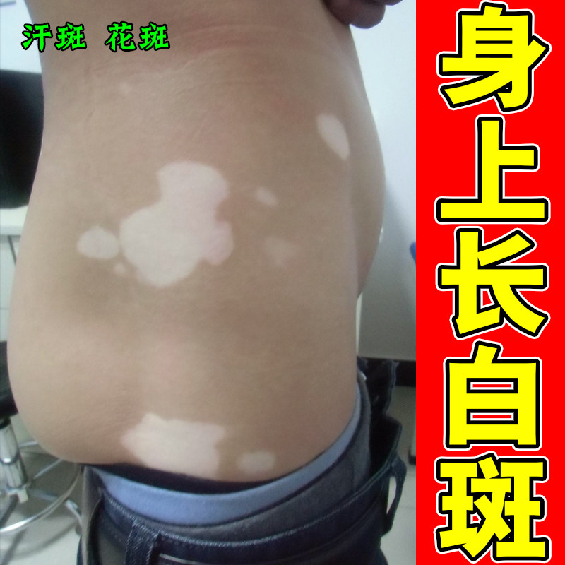 冶疗白斑殿风药快速消白斑专用脸部手部外用促进黑色素生长膏
