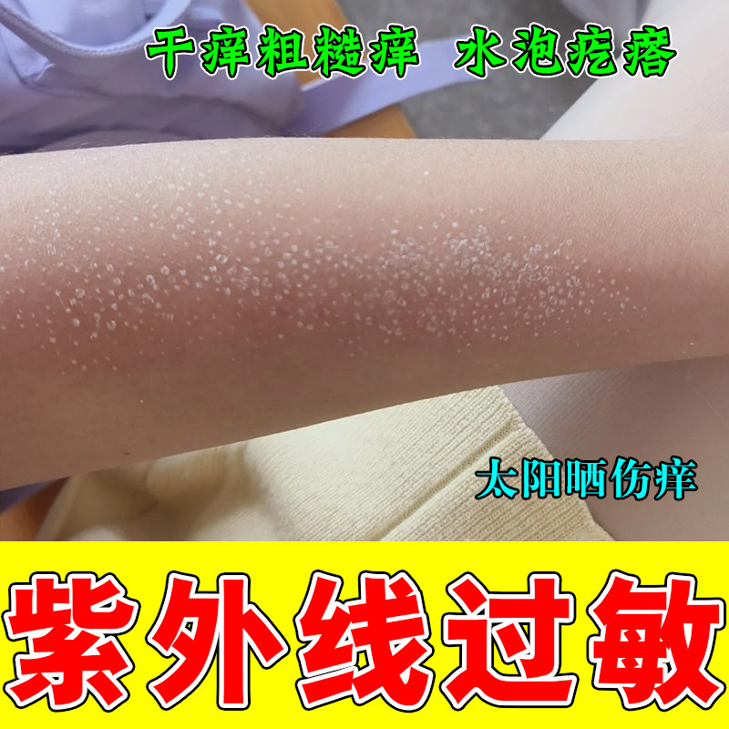 皮肤痒紫外线过敏胳膊长红斑疙瘩刺挠粗糙玫瑰红肿晒伤专用膏