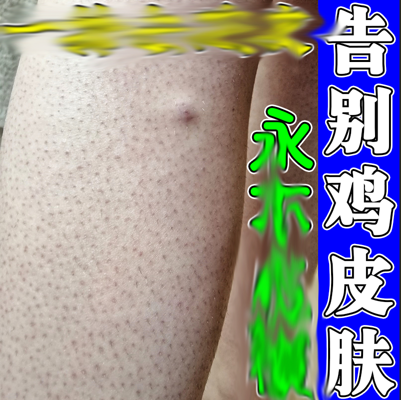 去除鸡皮疙瘩后背长红点黑点小颗粒粉刺手臂粗糙痒真菌感染药
