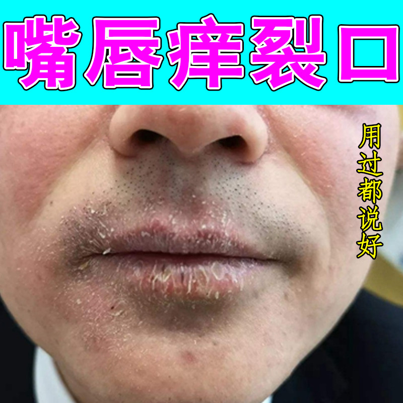 嘴唇痒裂口专用皮肤干燥裂口唇角干燥起皮干裂外用修护保湿药乳膏