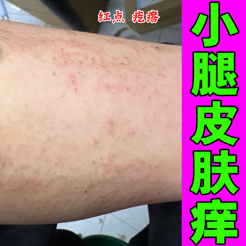 换季小腿痒皮肤干燥一热就痒掉皮鳞屑长疙瘩红点红斑专用修护药