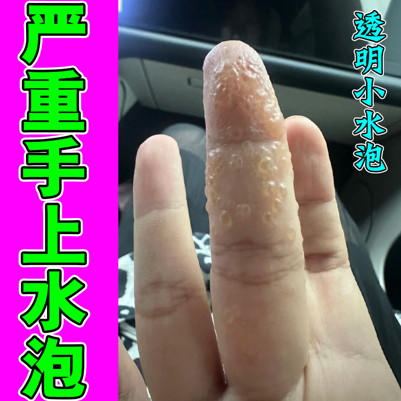 手指起痒药手上长小水泡真菌感染手指干燥蜕皮手掌爆皮过敏痒专用
