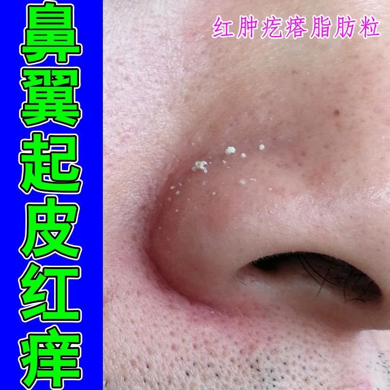 鼻翼起皮泛红干燥脂溢性蜕皮鼻子过敏红肿掉屑螨虫鼻红鼻头专用膏