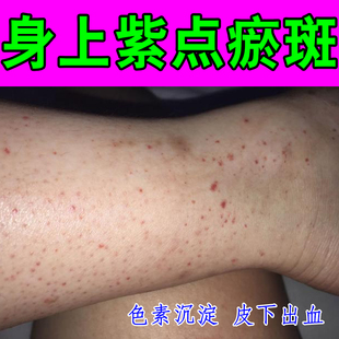 紫点专用冶色素过敏性紫点四肢皮下出血红点瘀斑瘀滞紫点红点修复