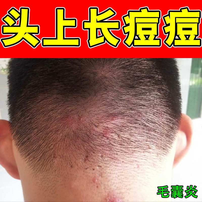 头皮毛囊堵塞红肿起脓包长痘痘硬块过敏后脑勺过敏长小红疙瘩专用