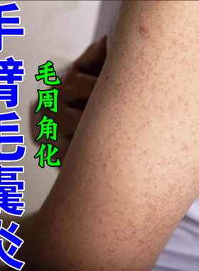 手臂毛囊毛周角化胳膊上小疙瘩皮肤痒前胸后背毛囊毛囊堵塞痒
