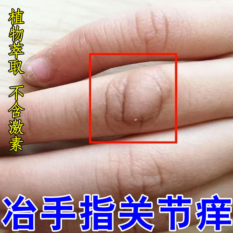 冶手指关节痒关节硬块起皮粗糙皮肤干燥痒粗糙裂口子脱皮专用修护