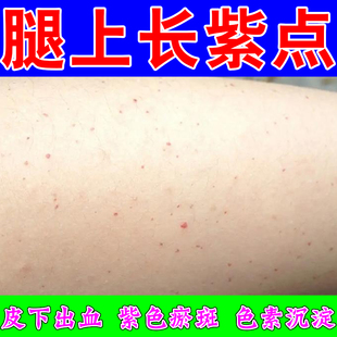 过敏性紫点过敏瘀斑四肢性皮下出血红点老年皮肤粗糙血管红点专用